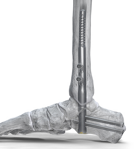Phantom ActivCore Nail System