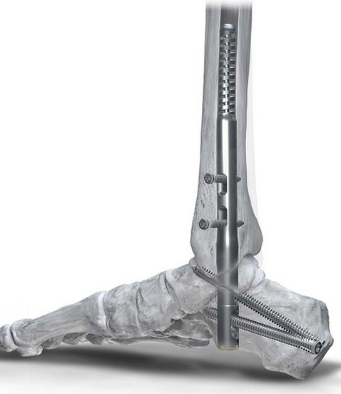 Phantom Hindfoot TC Nail