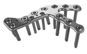 Calcaneal Sinus Tarsi Plates