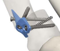 Minimally Invasive Bunion Plate