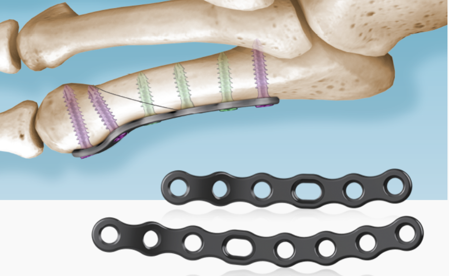 5Ms® Fracture System Neck Plate