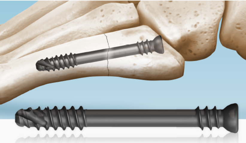 5Ms® Fracture System Jones Fracture Screw