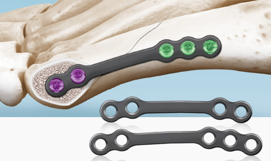 5Ms® Fracture System Bunionette Plate