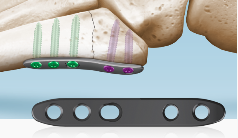 5Ms® Fracture System Plantar Plate