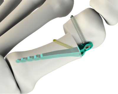 MiniBunion plate