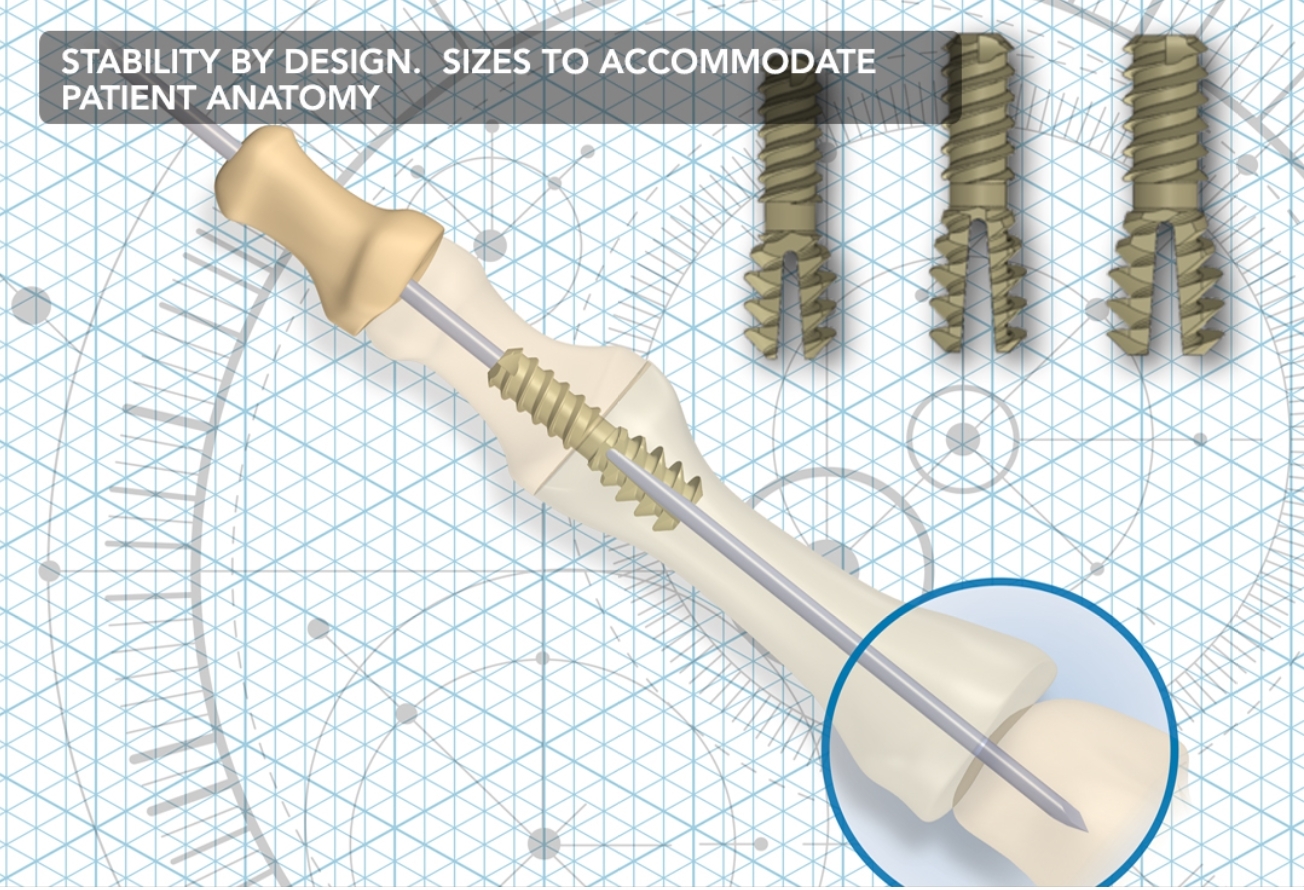 Hammerfix Peek Hammertoe Implant