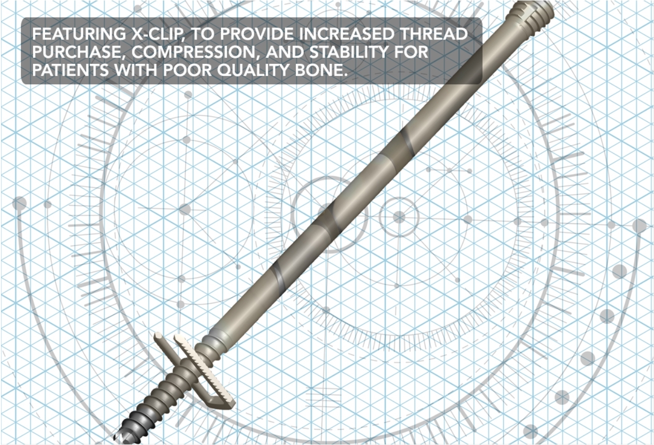 Axis Fixation Beam