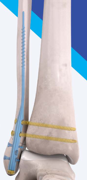 Flex-Thread Fibula Nail