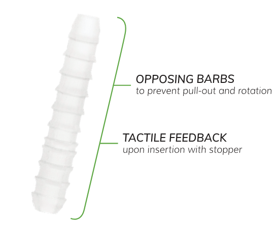 OSSIOfiber® Hammertoe Fixation Implant