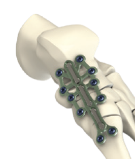 Dynaforce Medial Column Tri-Joint plate