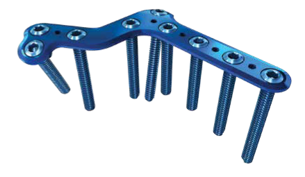 Calcaneal Combo Plate