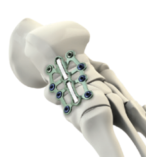 Dynaforce Medial Column Proximal plate