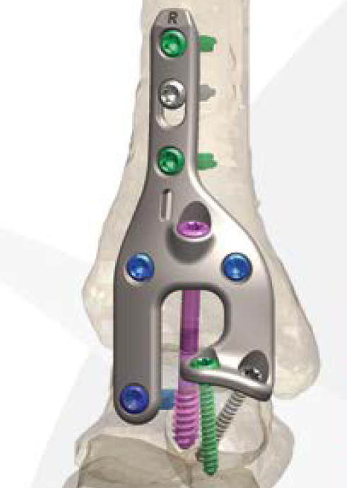Alignx Ankle Fusion Lateral Plate