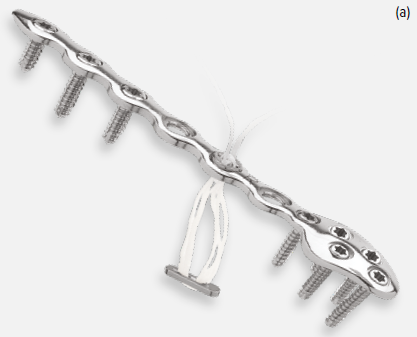 Arthrex Fibula Distal Locking Plate