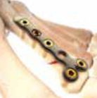 Ortholoc 3Di T plate