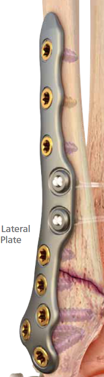 Ortholoc 3Di LP Fibula plate