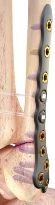 Ortholoc 3Di LP Fibula plate