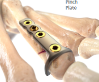 Ortholoc 3Di straight Pinch plate
