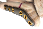Ortholoc 3Di Jones plate