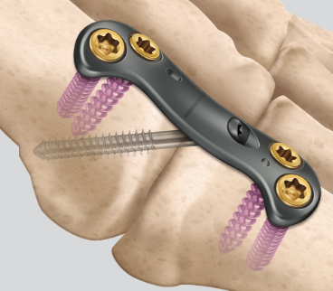 Ortholoc 3Di Crosscheck MTP plate