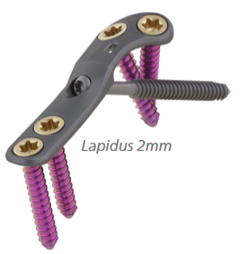 Ortholoc 3Di Crosscheck Lapidus plate