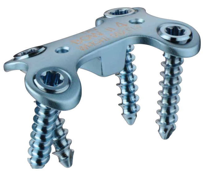 Darco MFS Bow II plate