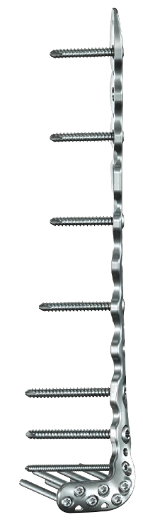ANTHEM Antero-Lateral Distal Tibia Plate