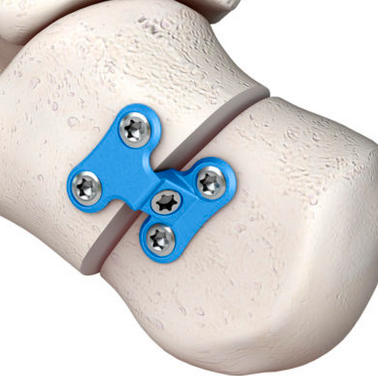 UNITE Medial Displacement Calcaneal Osteotomy Plate
