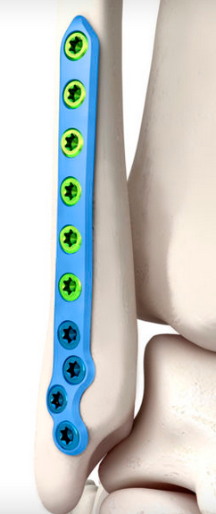 Fibula Posterior Plate