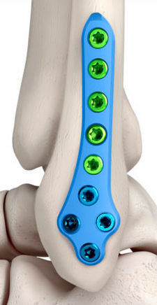 Lateral Fibula Plate