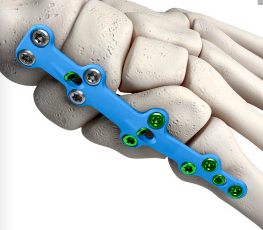 Medial Column Plate