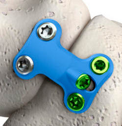Talar Navicular Plate